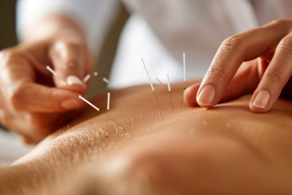 Dry Needling