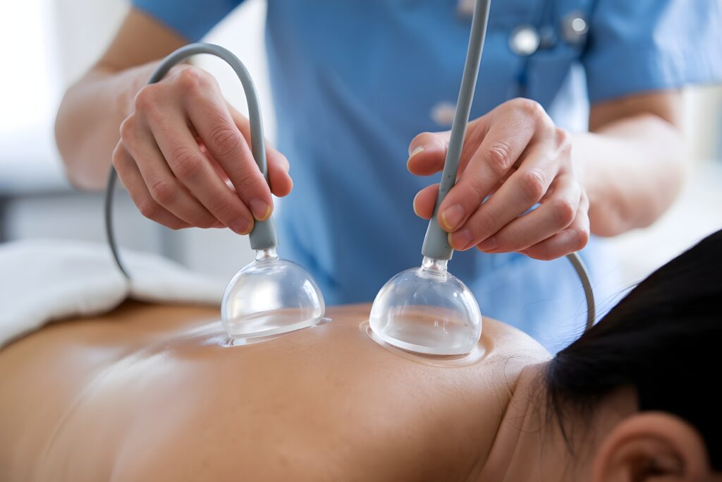 Cupping Therapy