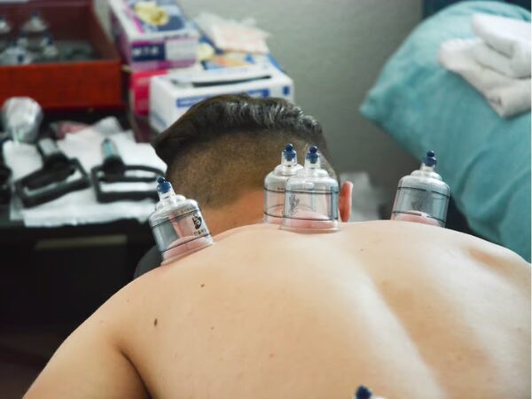 Cupping Therapy Price Guide