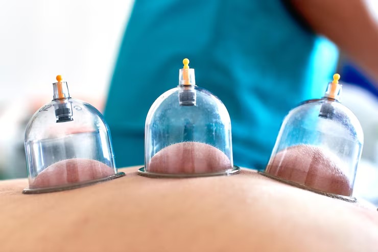 Before and After Cupping Therapy